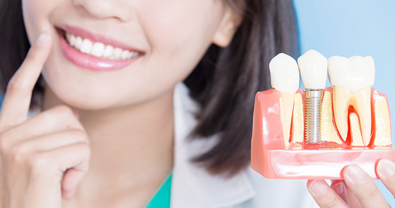 dental implants singapore