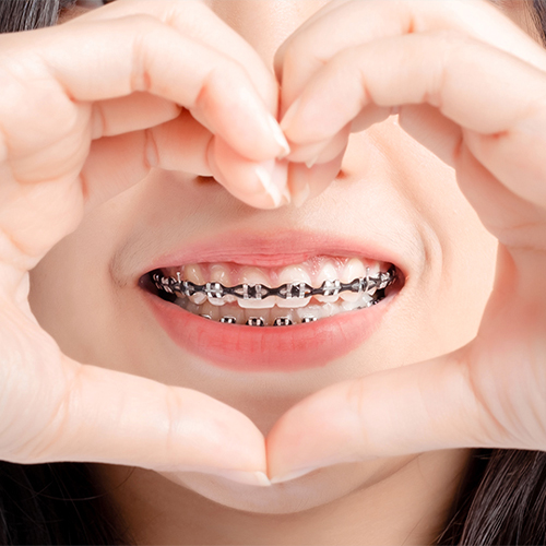 Orthodontic Treatment Singapore Aloha Dental Clinic 